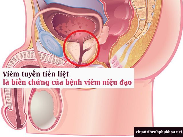 Viêm tuyến tiền liệt là biến chứng của bệnh viêm niệu đạo