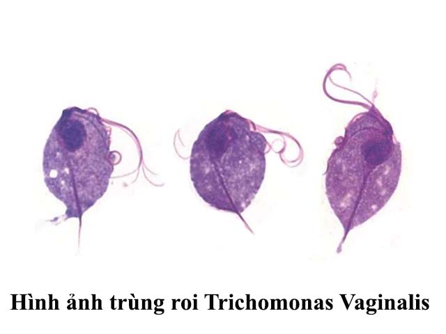 Dấu hiệu bệnh viêm âm đạo do trùng roi Trichomonas