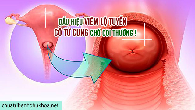 Triệu chứng của bệnh viêm lộ tuyến cổ tử cung