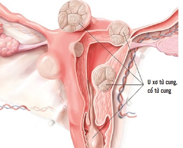 Hình ảnh u xơ tử cung, cổ tử cung