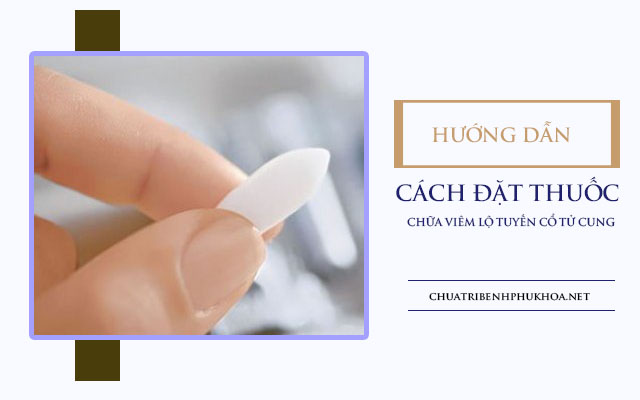 cách đặt thuốc trị viêm lộ tuyến cổ tử cung