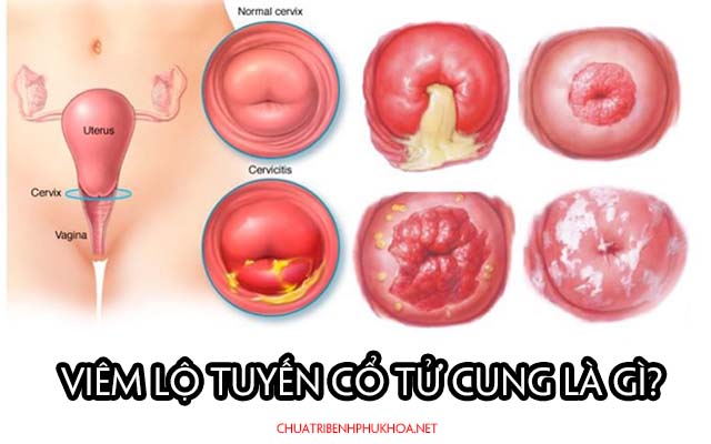 Cách để phân biệt lộ tuyến cổ tử cung