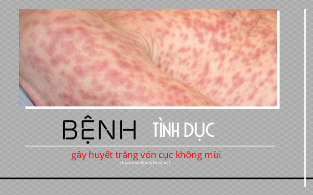 huyết trắng vón cục không mùi2