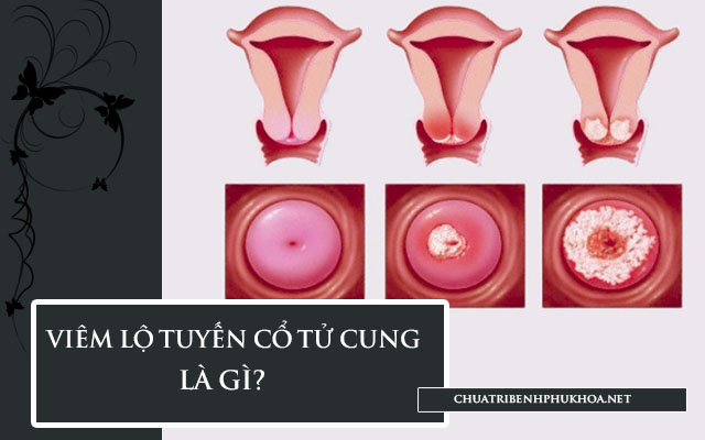 Viêm lộ tuyến cổ tử cung có quan hệ được không 1