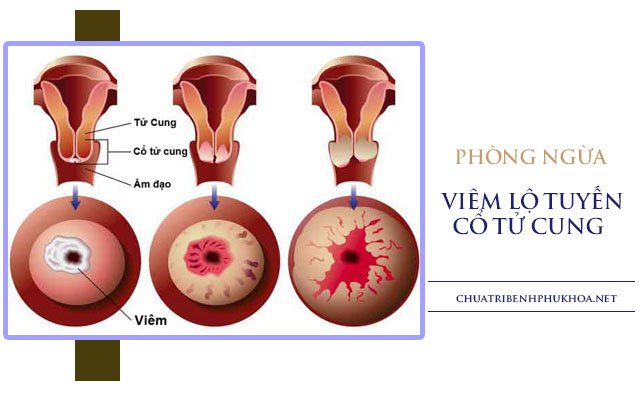 Viêm lộ tuyến cổ tử cung có quan hệ được không 3