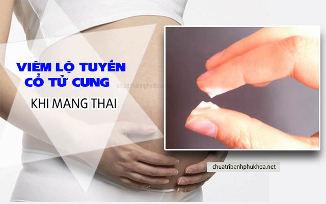 Viêm lộ tuyến cổ tử cung khi mang thai 