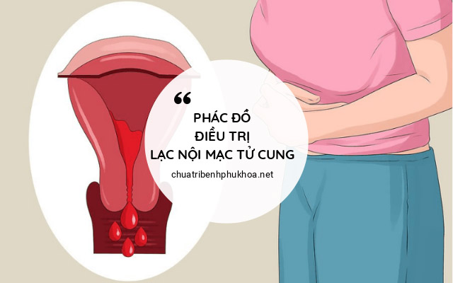 phác đồ điều trị lạc nội mạc tử cung