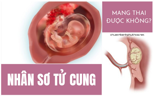 nhân xơ tử cung có mang thai được không1